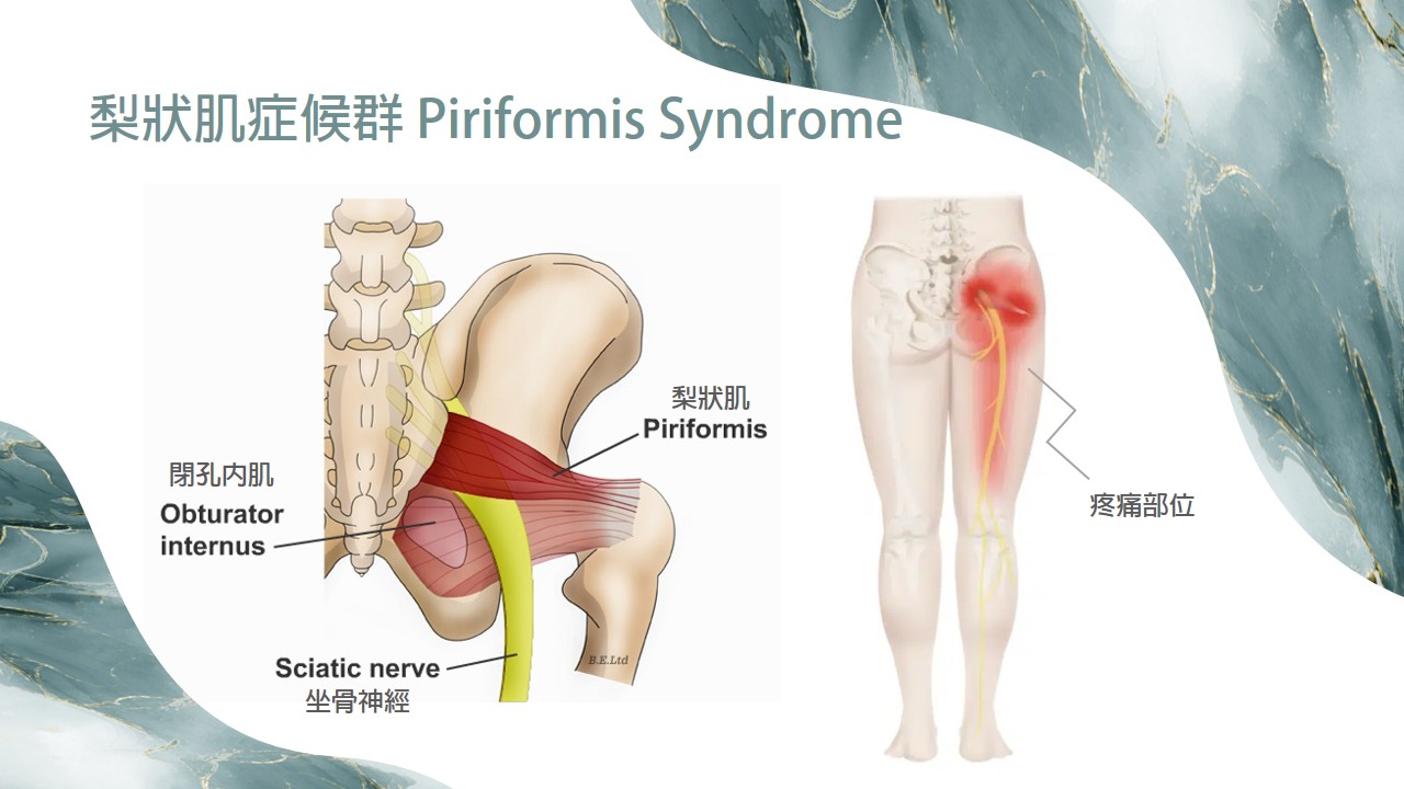 梨狀肌症候群示意圖 1